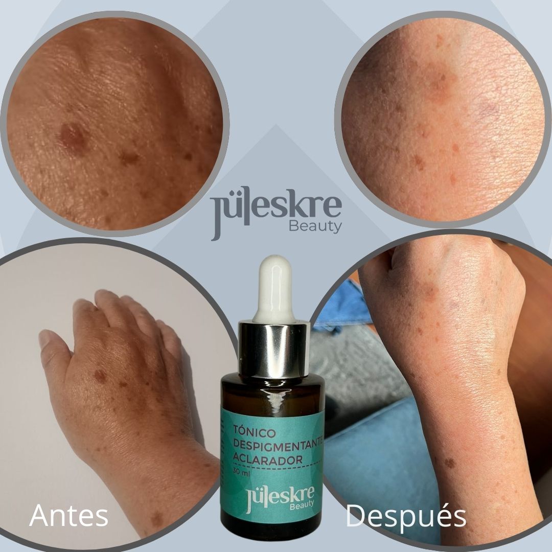 ¿Cómo Controlar el Melasma?: Guía Completa para una Piel Uniforme